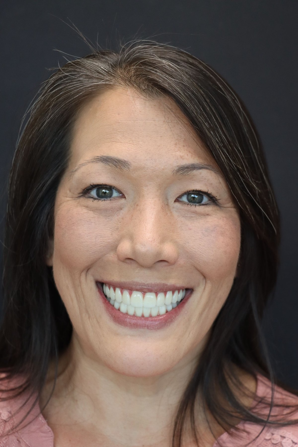Redmond Dental Studio Smile Makeover — after treatment, patient 2