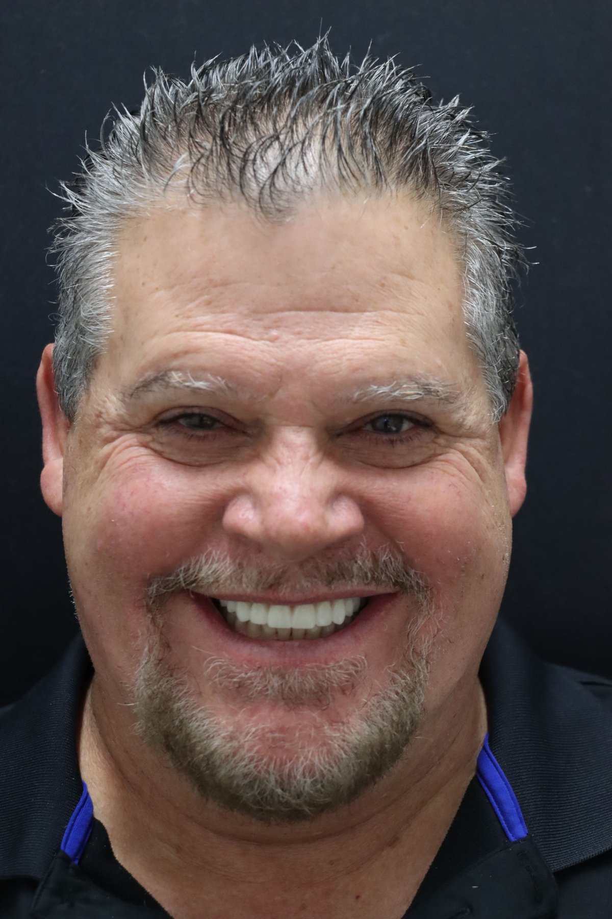 Redmond Dental Studio Full Smile Restoration — before treatment, patient 3