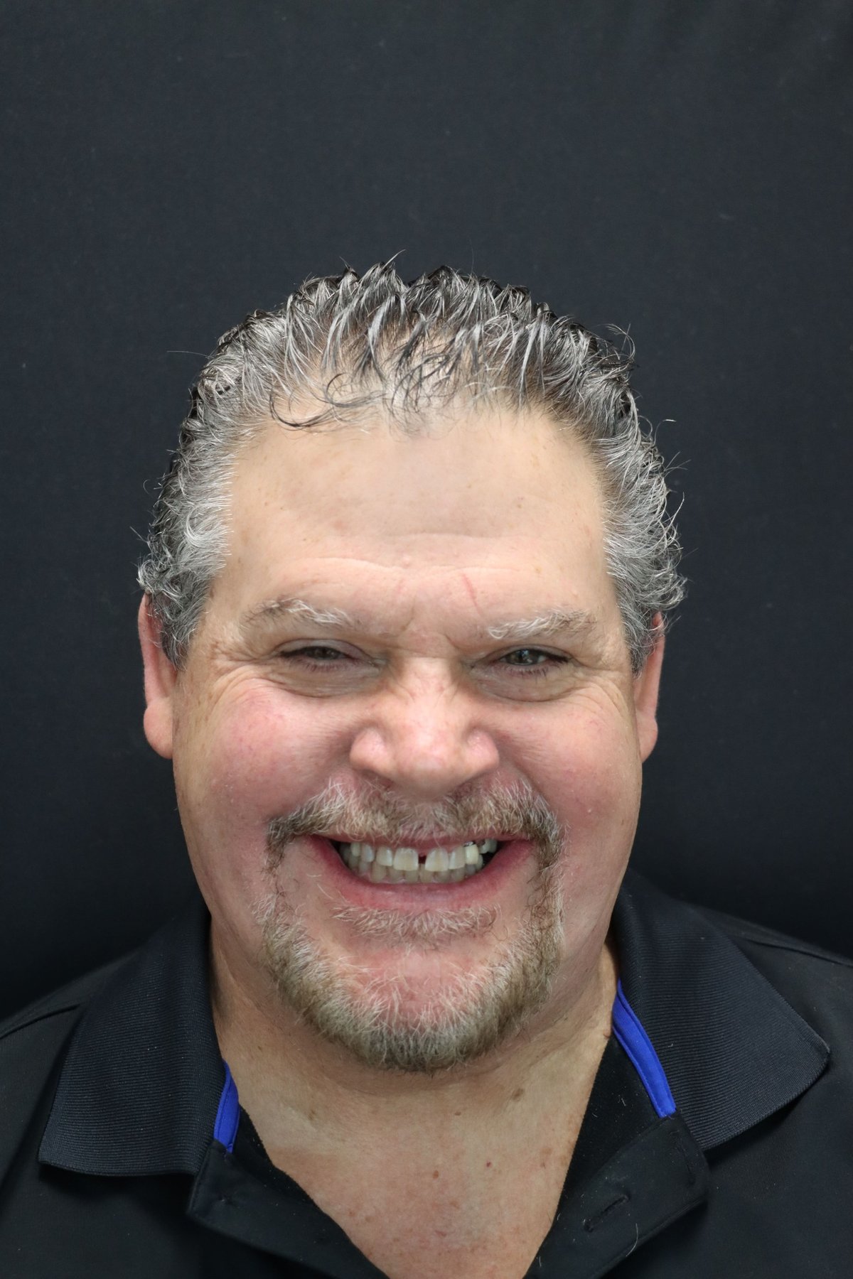 Redmond Dental Studio Full Smile Restoration — after treatment, patient 3