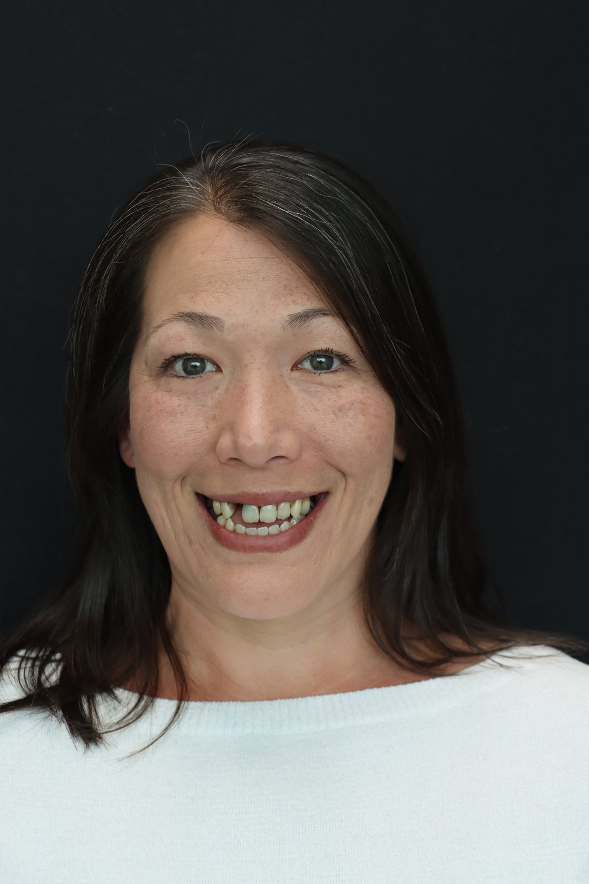 Redmond Dental Studio Smile Makeover — before treatment, patient 2